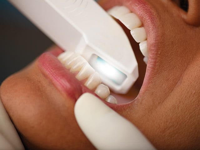 Intraoralscanner in Köln