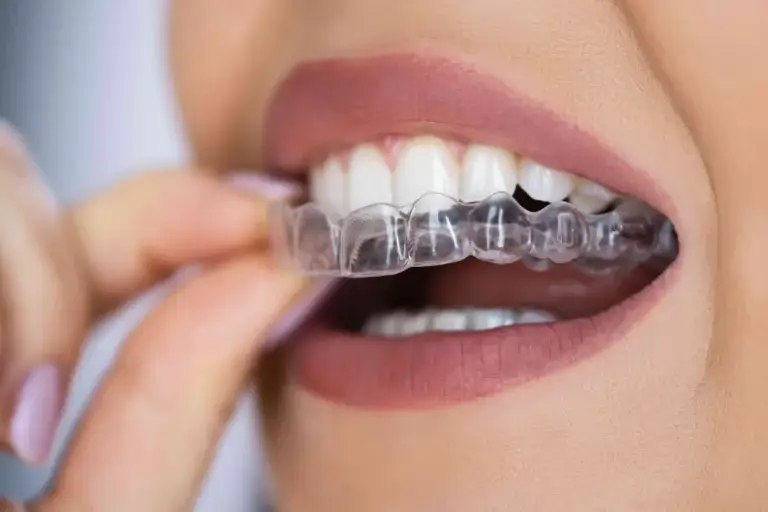 Invisalign in Köln
