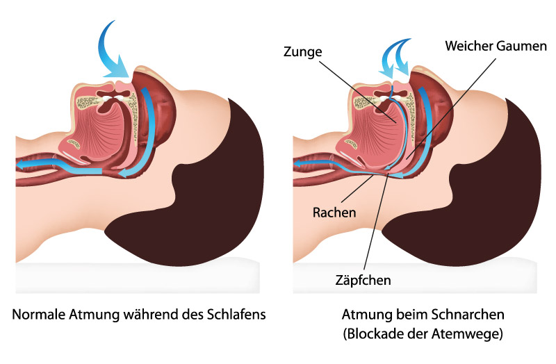 Schnarchen Umweltzahnmedizin Köln - der Gaumen: warum schnarchen wir?