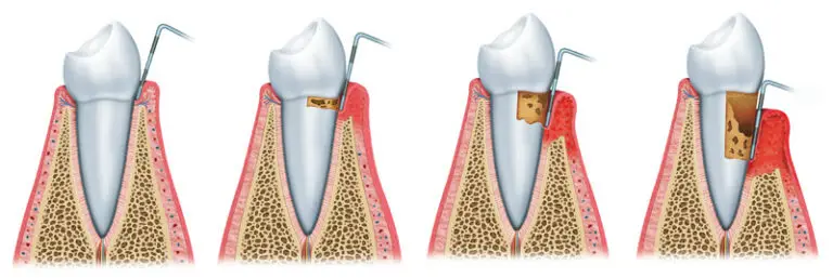 Gingivitis vs. Parodontitis