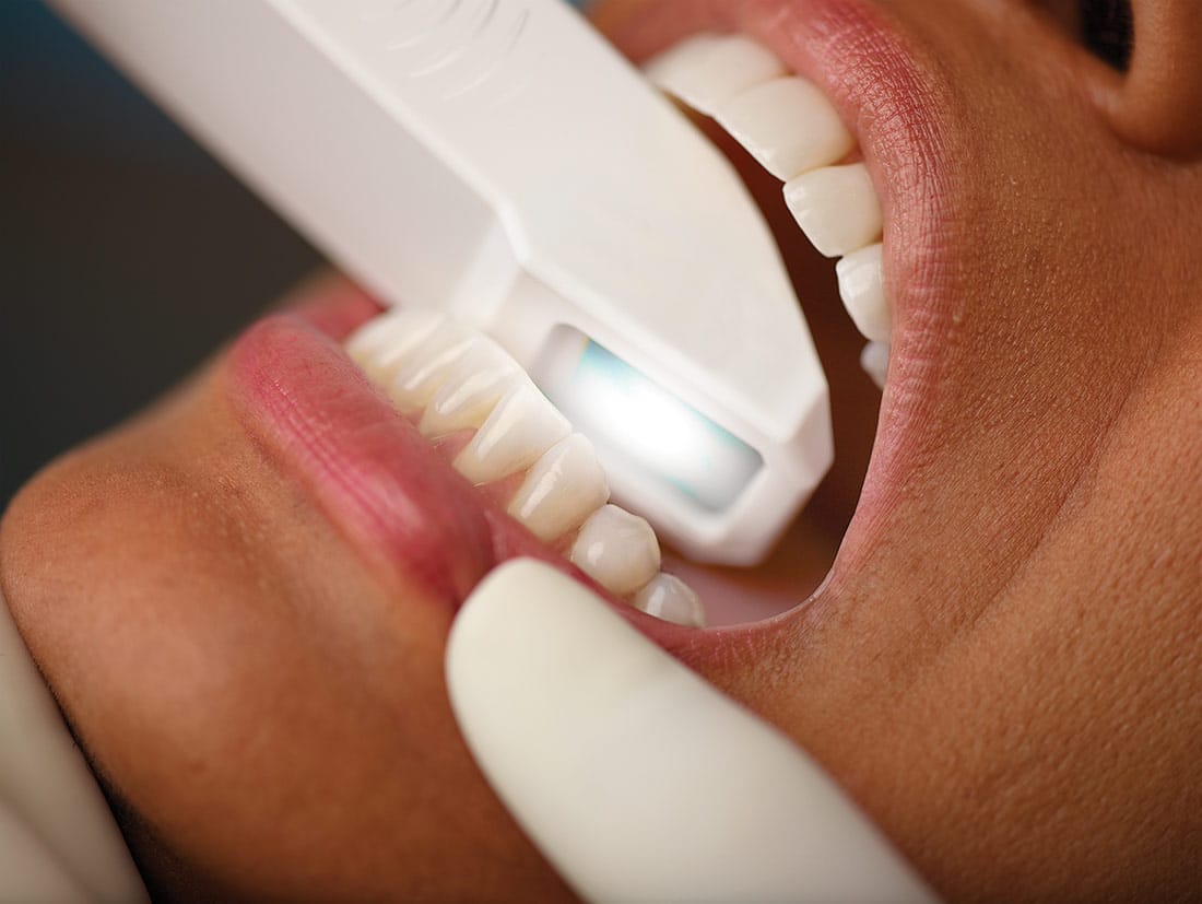 Intraoralscanner - Digitale abdruckfreie Zahndiagnostik in Köln