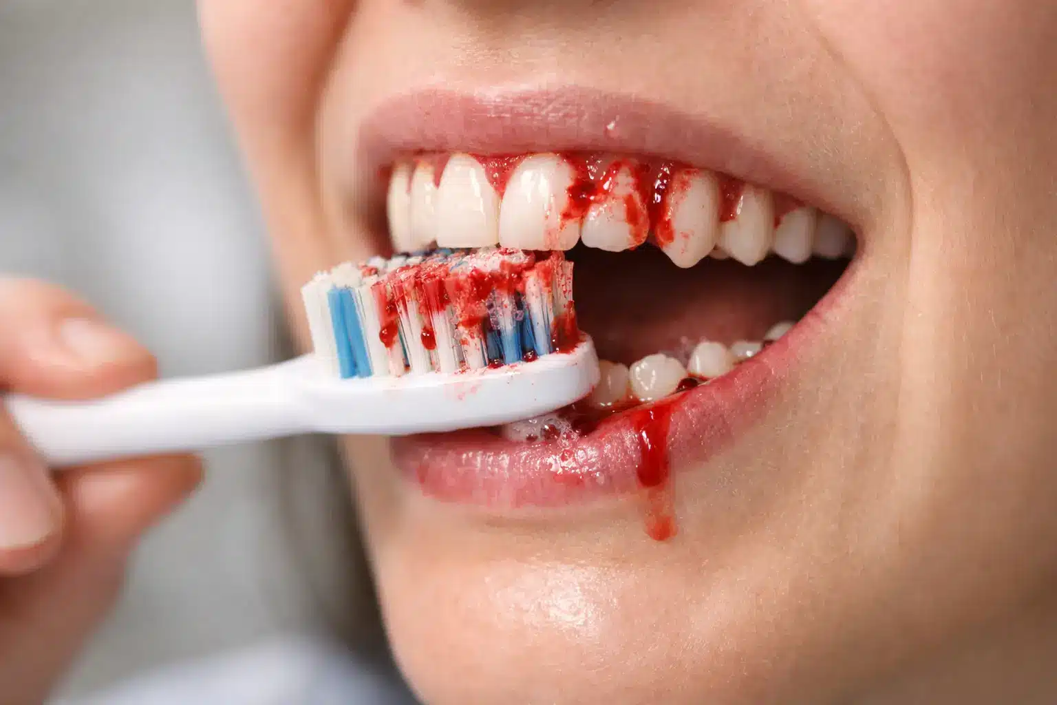 Warum blutet Zahnfleisch beim Putzen?